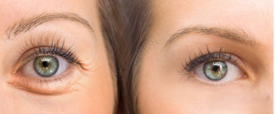 What Is a Fractional CO2 Laser? Technology and Benefits