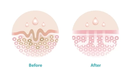 What Is a Fractional CO2 Laser? Technology and Benefits