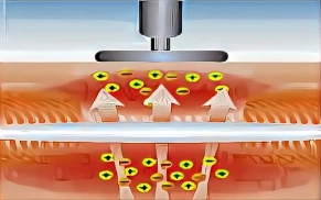 What Is 448kHz CET Technology and Why Is It Becoming a Trend in the Aesthetic Industry?