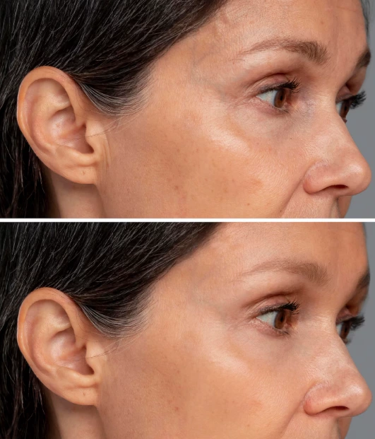 What Can 448kHz CET Technology Do and Why Can It Deliver Multi-Effect Treatments?