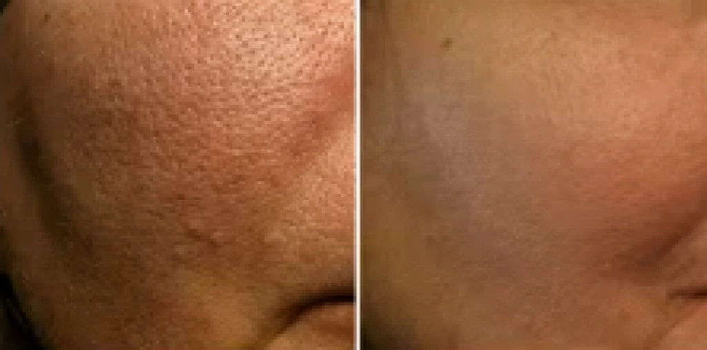 Handheld HIFU Series(Part 3) |How Does Ultherapy Achieve "Deep Lifting"?