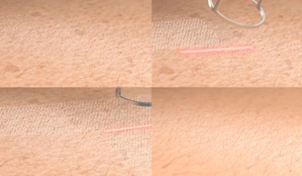 Fractional CO₂ Laser vs Other Skin Resurfacing Treatments: Which Option Is Best?