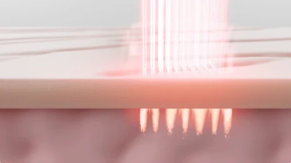 Fractional CO₂ Laser vs Other Skin Resurfacing Treatments: Which Option Is Best?