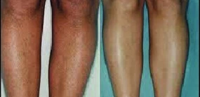 Painless Ipl Hair Removal Machine