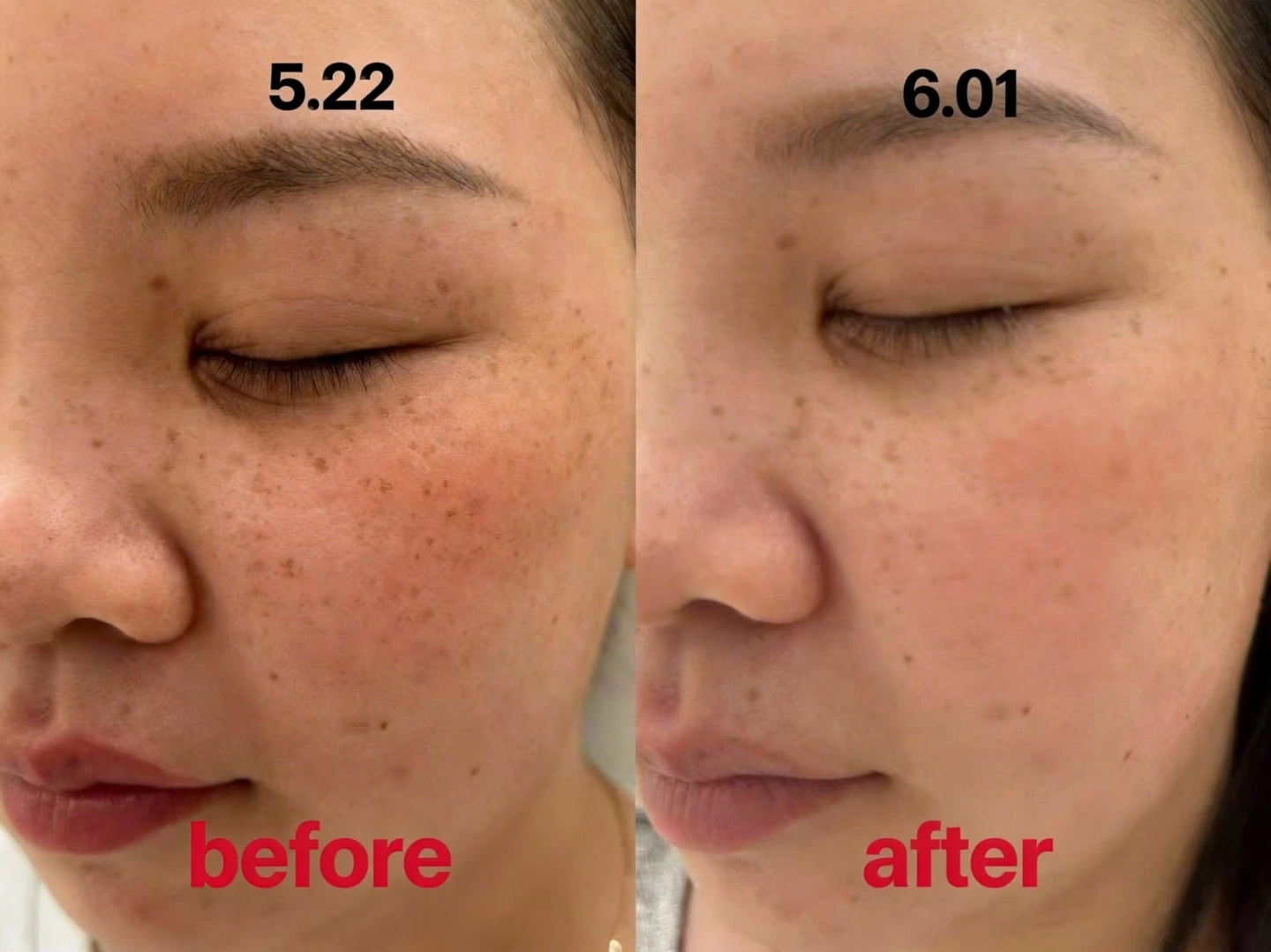 IPL Treatment for Freckles, one session