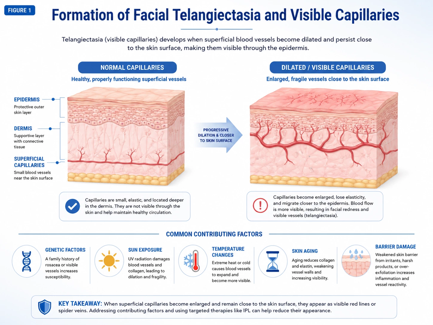 Formation of Facial Telangiectasia and Visible Capillaries Diagram showing the formation of facial telangiectasia and visible capillaries as superficial blood vessels become dilated and more visible through the skin