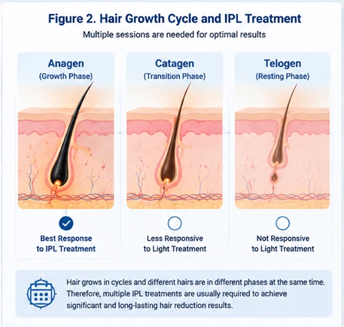 Hair growth cycle diagram showing anagen catagen telogen phases for IPL hair removal treatment