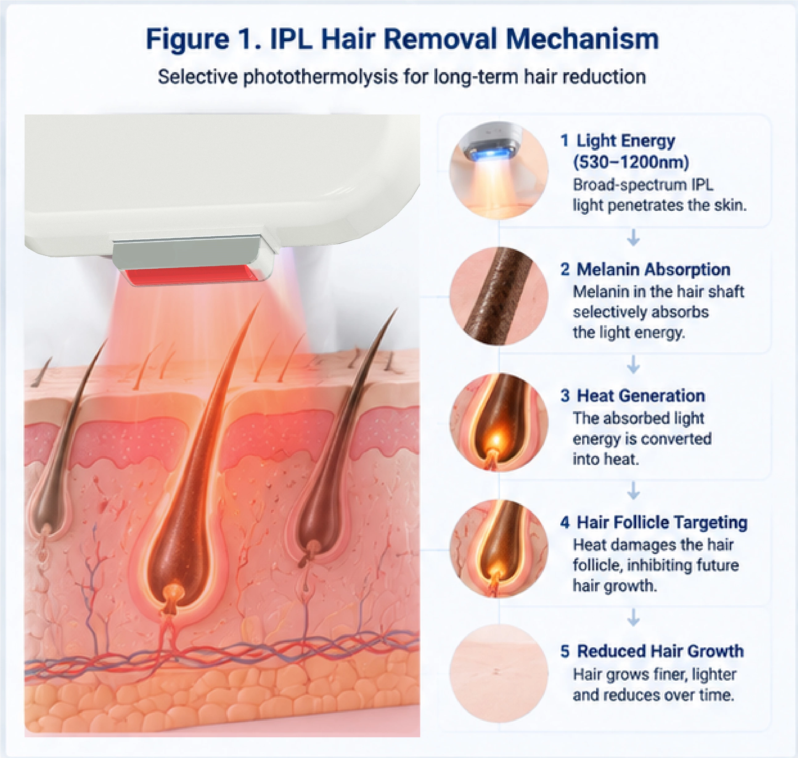 IPL hair removal mechanism showing melanin absorption and selective photothermolysis targeting hair follicles