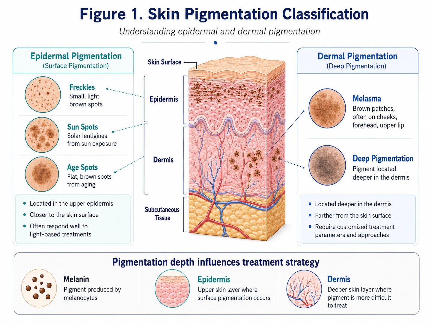 Diagram showing epidermal and dermal pigmentation types including freckles sun spots and melasma