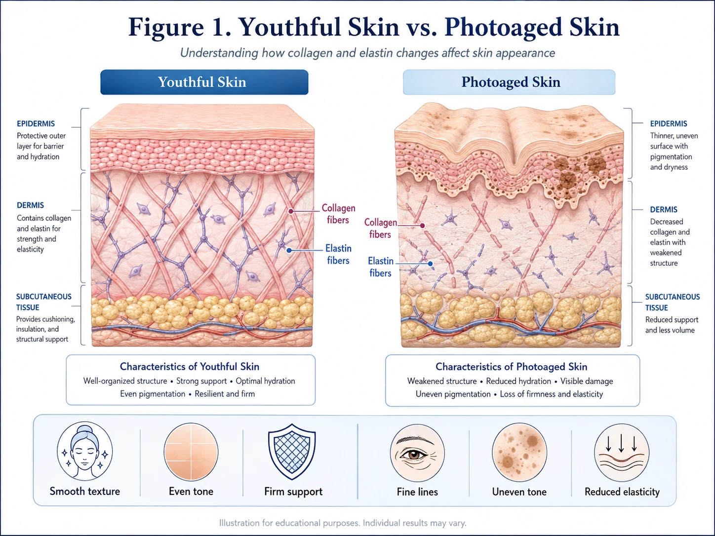youthful-vs-photoaged-skin-collagen-elastin Comparison of youthful and photoaged skin showing differences in collagen, elastin, skin texture and pigmentation