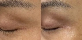 Painless Ipl Hair Removal Machine